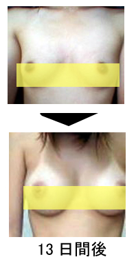 出産後の授乳で垂れた胸 バスト を元に戻すためのバストアップのサプリメントレビュー グラマー 産後の垂れ た胸に効くバストアップサプリメント グラマー でレビュー 口コミどおり 好評